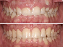 dientes incluidos ortodoncia vitoria logrono